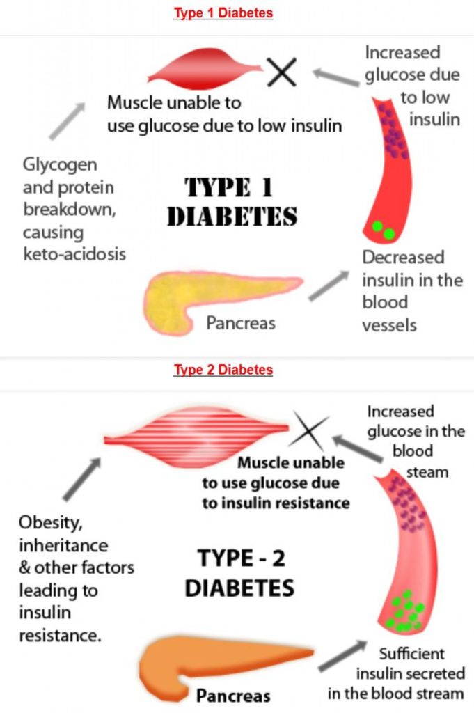 Diabete di Tipo 1 e 2.