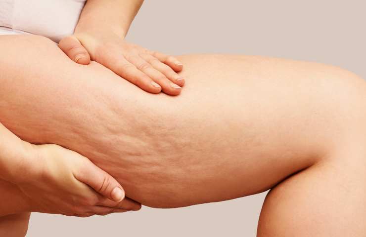 eliminare cellulite