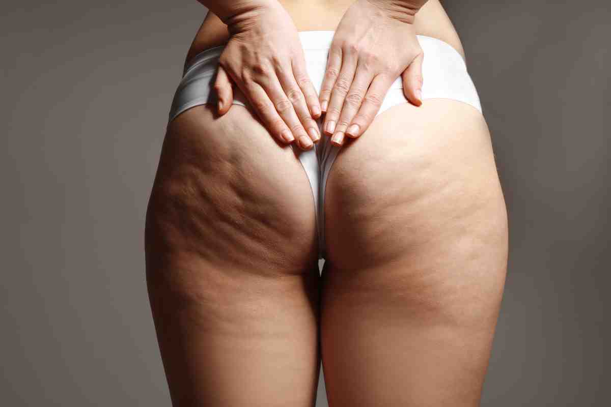 rimedi contro la cellulite