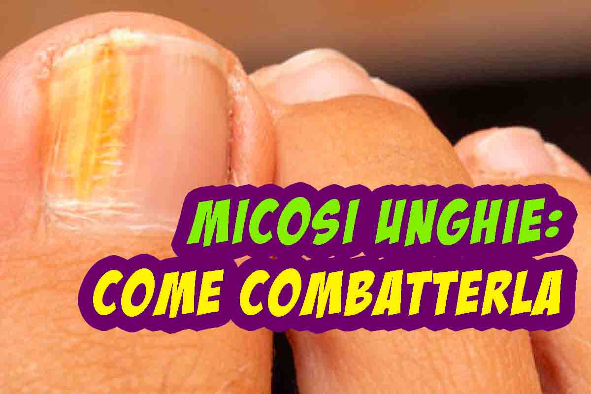 Micosi delle unghie, ecco come rimediarvi