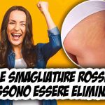 smagliature rosse, tutti i rimedi naturali