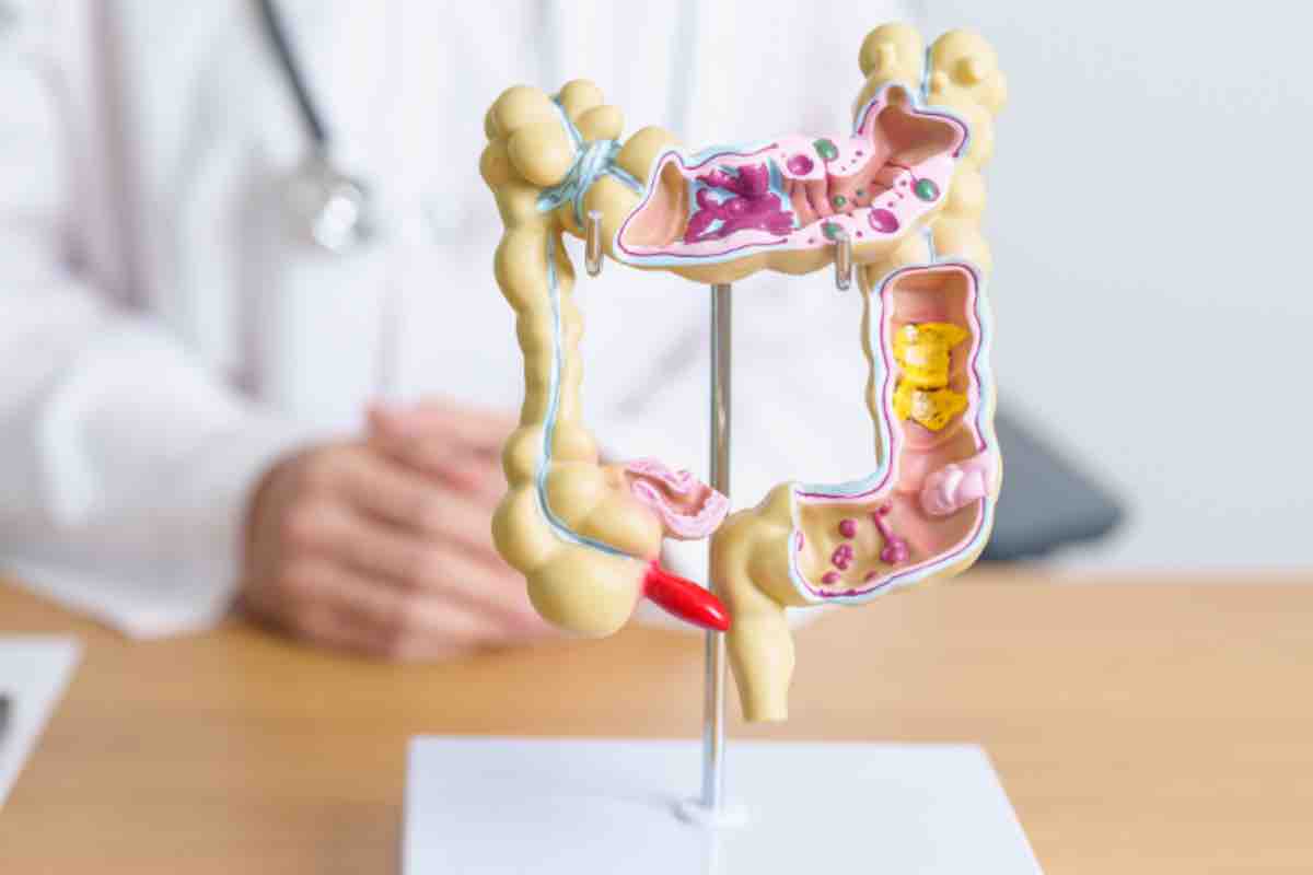 Diverticolite sintomi