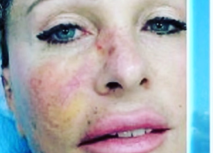 Paola Ferrari e il carcinoma alla pelle del viso: "Pensavo fosse solo un brufolo"